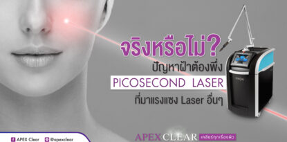 Pico Laser Melasma Treatment