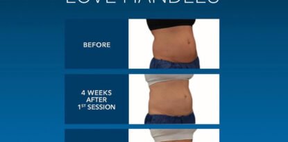Revealing the widespread appeal of this non-invasive treatment for reducing fat.