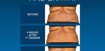 CoolSculpting as an Effective Non-Invasive Fat Reduction Treatment