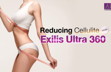 Reducing Cellulite with Exilis Ultra 360 and Advanced Technology