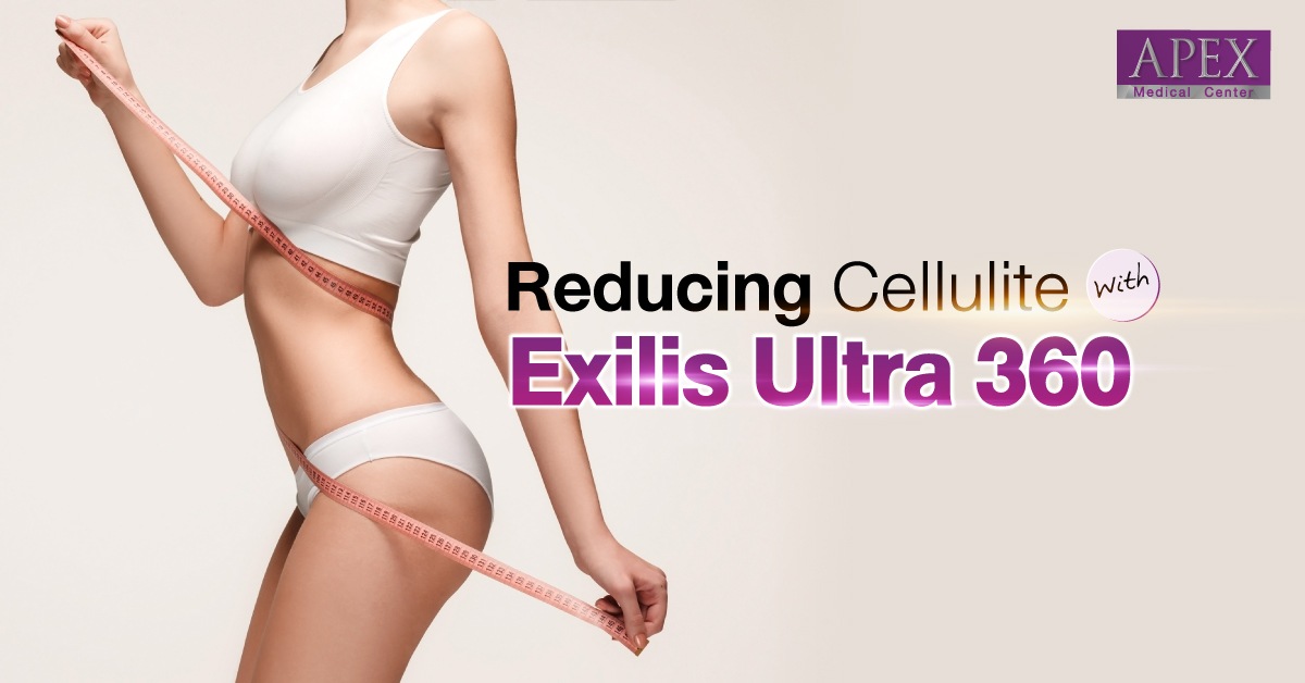Unlocking the Advantages of Exilis Ultra 360: Advancements in Technology for Effective Cellulite Reduction