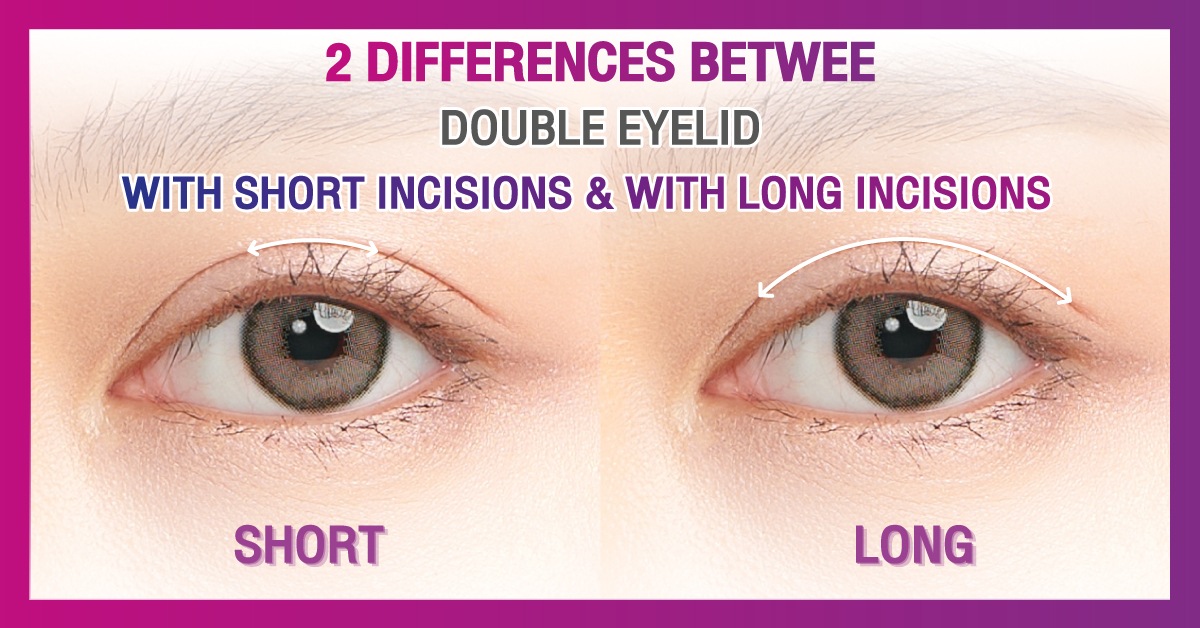 2 differences between double eyelid surgery with short incisions and with long incisions 