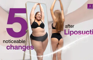 5 noticeable changes after liposuction surgery