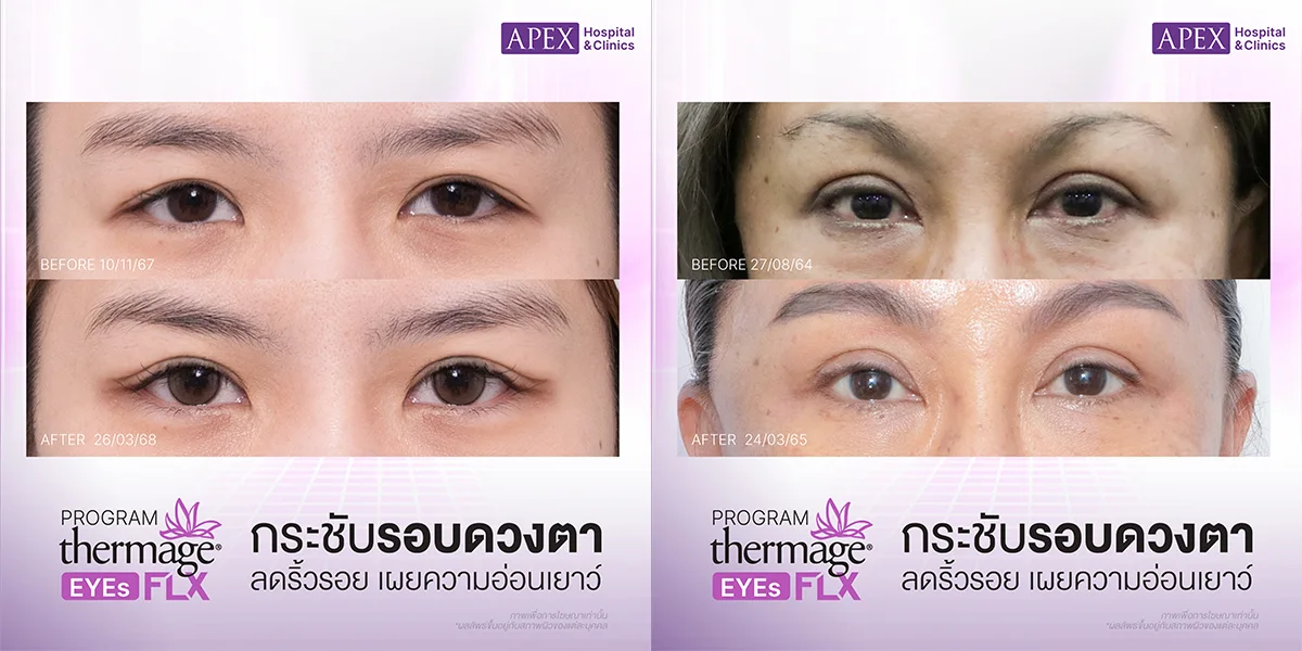 Thermage Eyes รีวิว