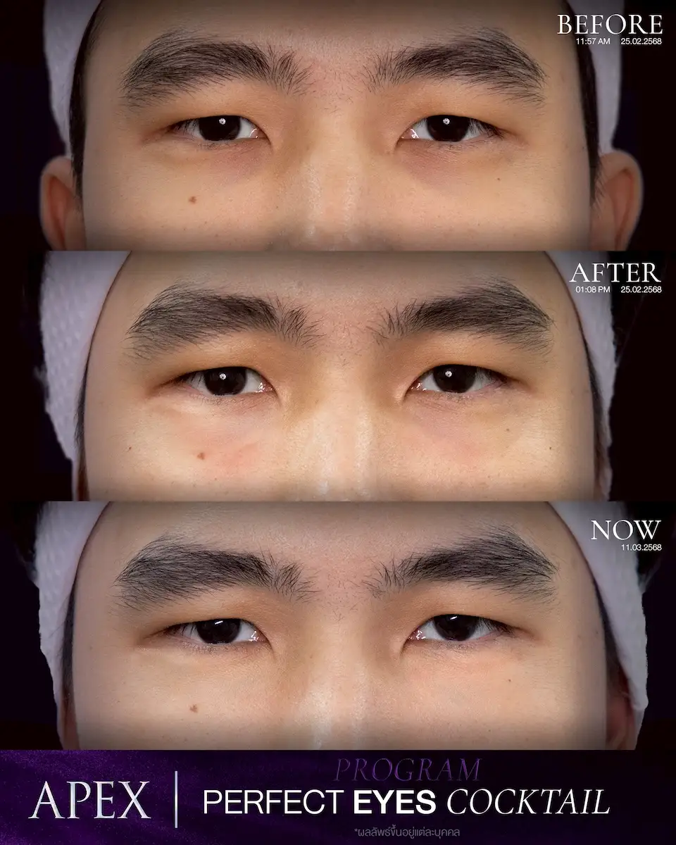 รีวิวฟิลเลอร์ใต้ตา ผู้ชาย