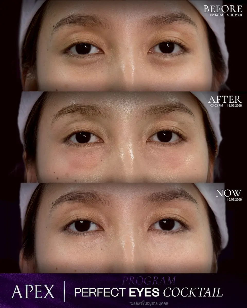 ฟิลเลอร์ใต้ตา ผู้หญิง