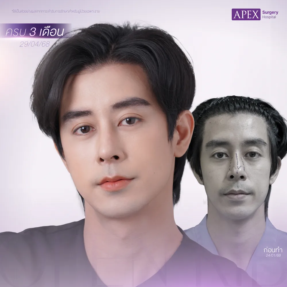 รีวิว ทรงจมูกผู้ชาย