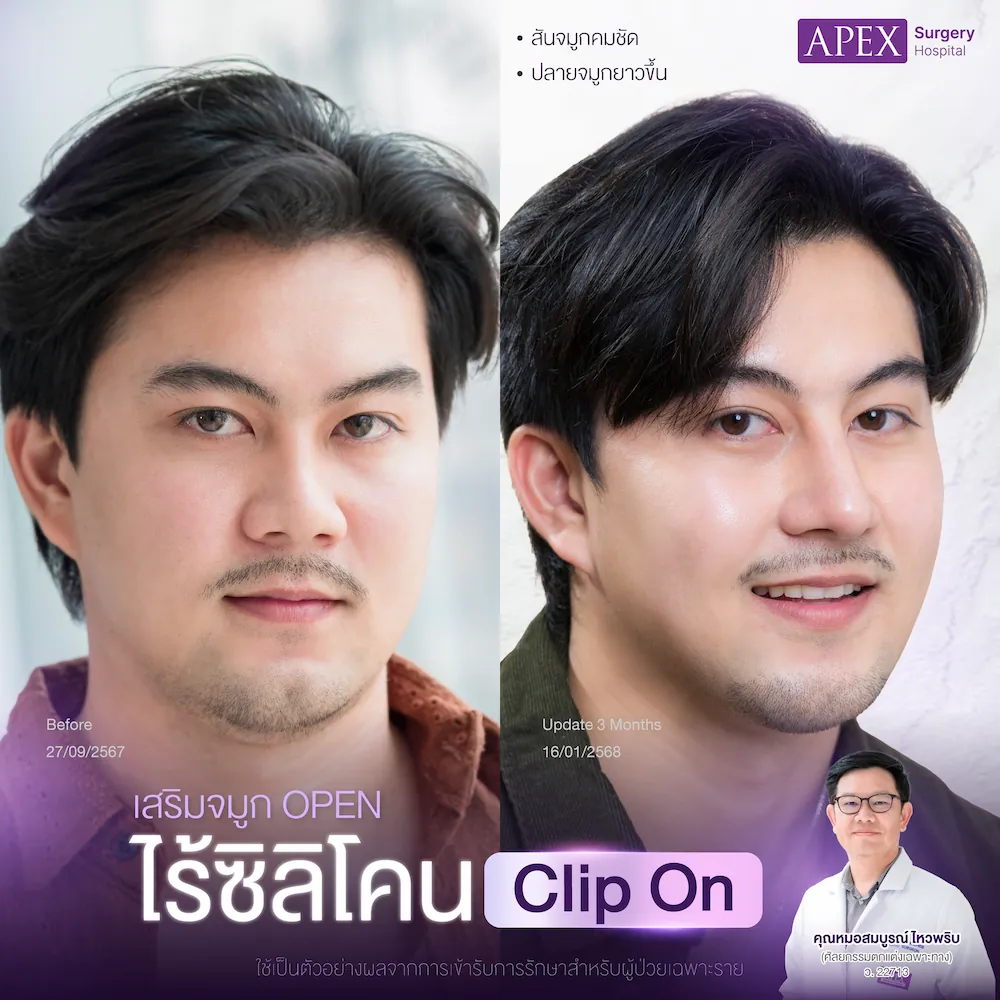 รีวิว ทรงจมูกผู้ชาย