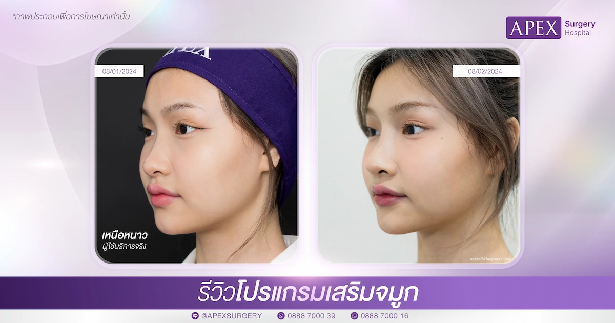 รีวิวเสริมจมูก