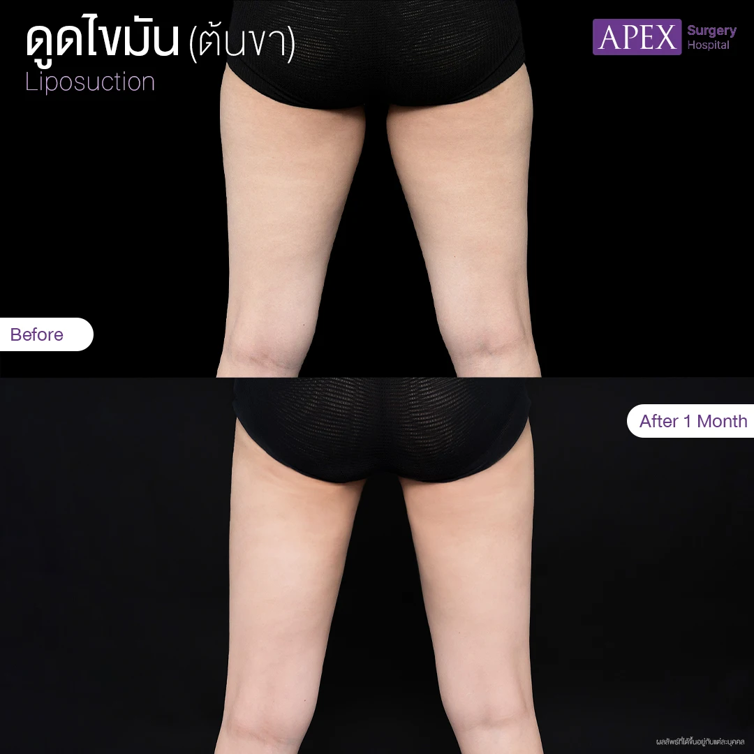 ดูดไขมันขา รีวิว