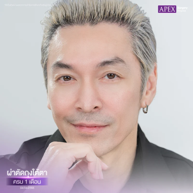 ผ่าตัดถุงใต้ตา ครบ 1 เดือน