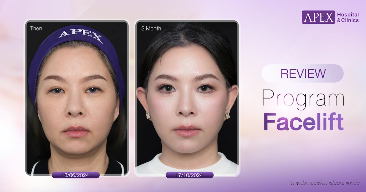 ดึงหน้าลดริ้วรอย