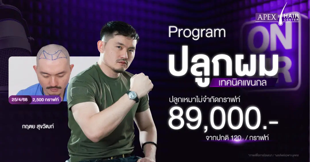 ปลูกผม