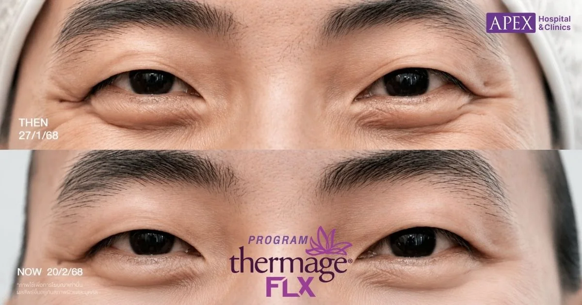 Thermage Eye แก้หนังตาตก