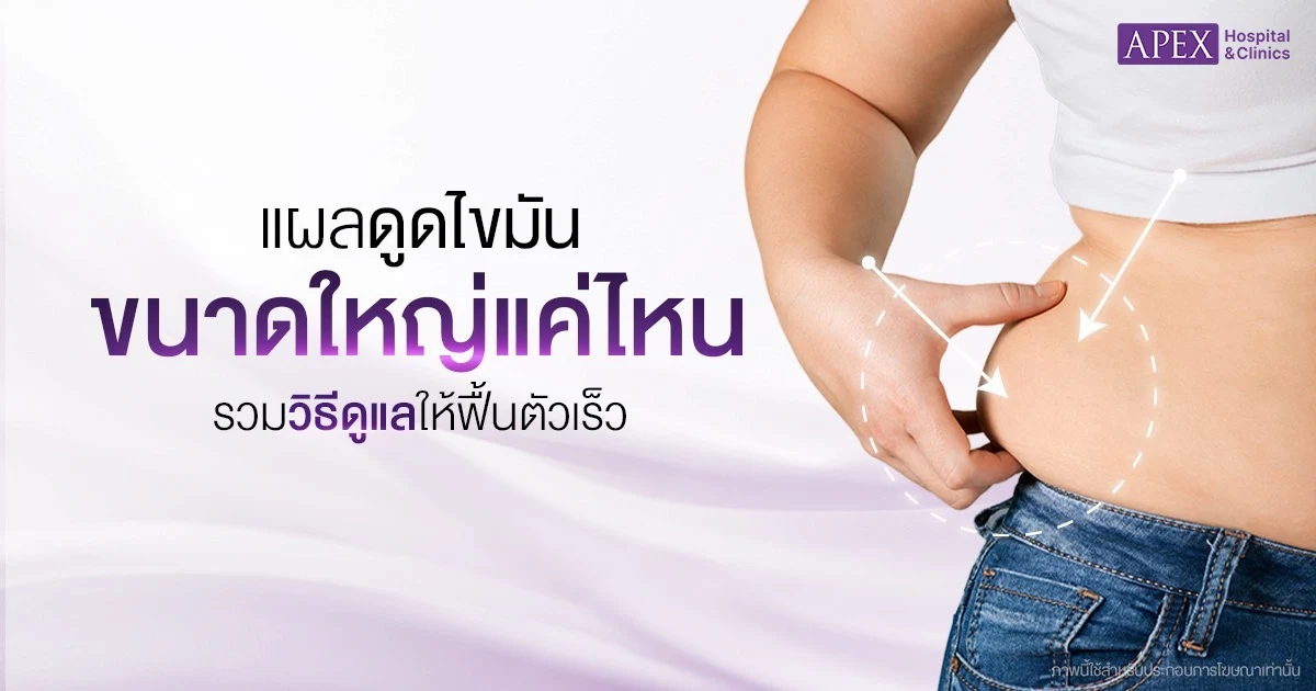 แผลดูดไขมัน