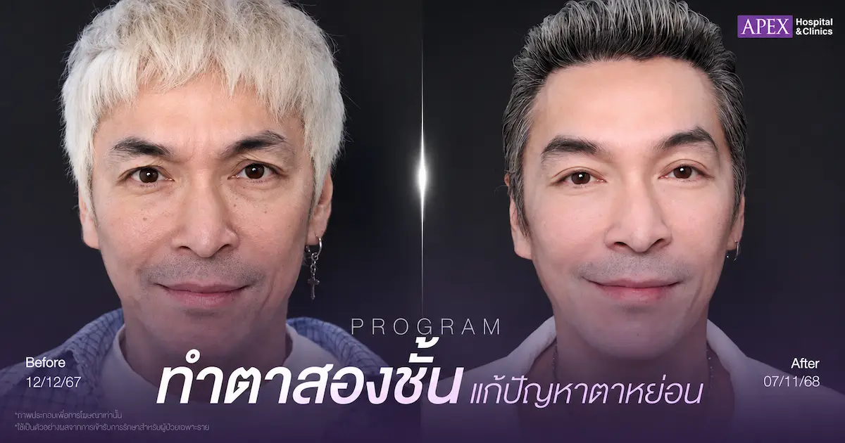 ผ่าตัดตาสองชั้น แก้หนังตาตก