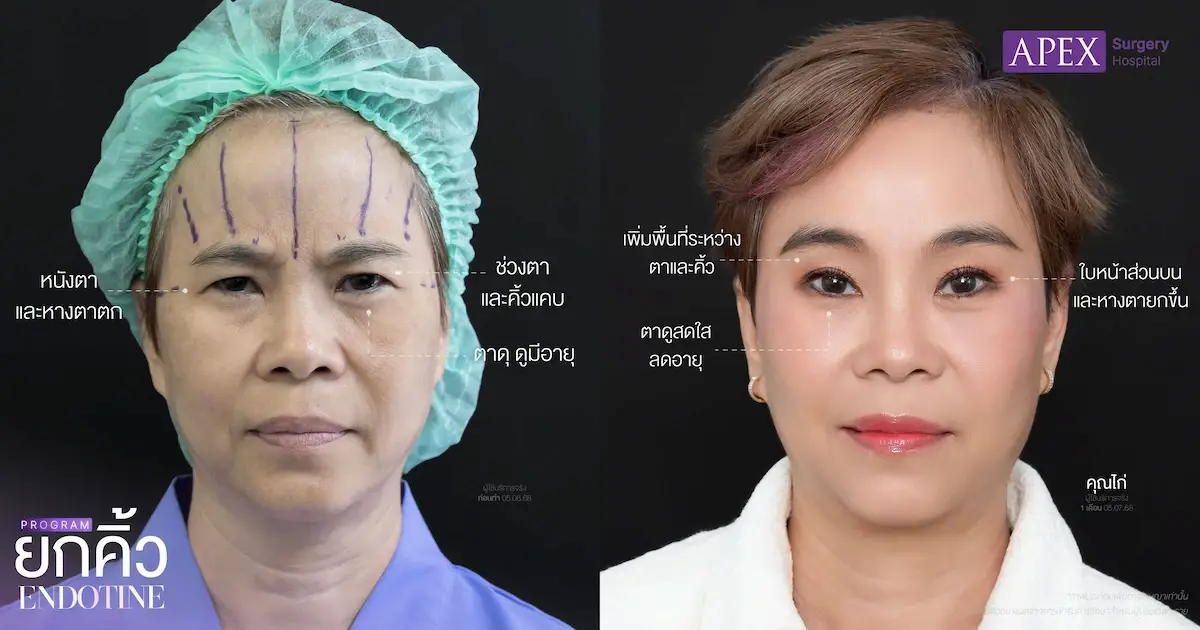 ผ่าตัดยกคิ้วเอนโดไทน์ แก้หนังตาตก