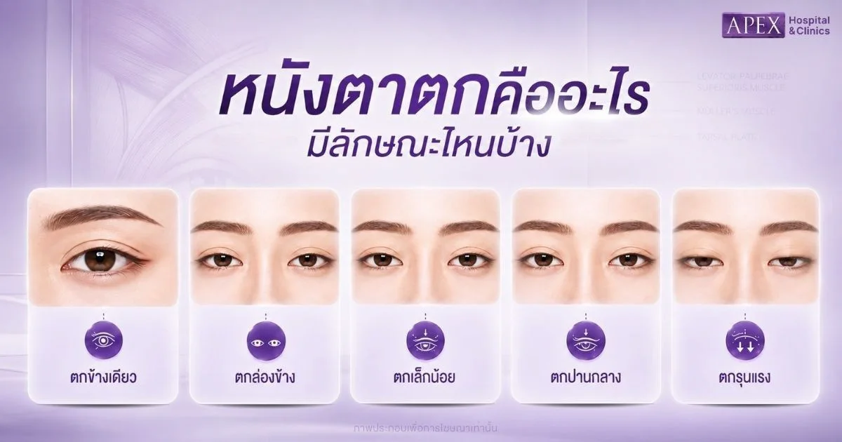 หนังตาตก คืออะไร มีลักษณะไหนบ้าง