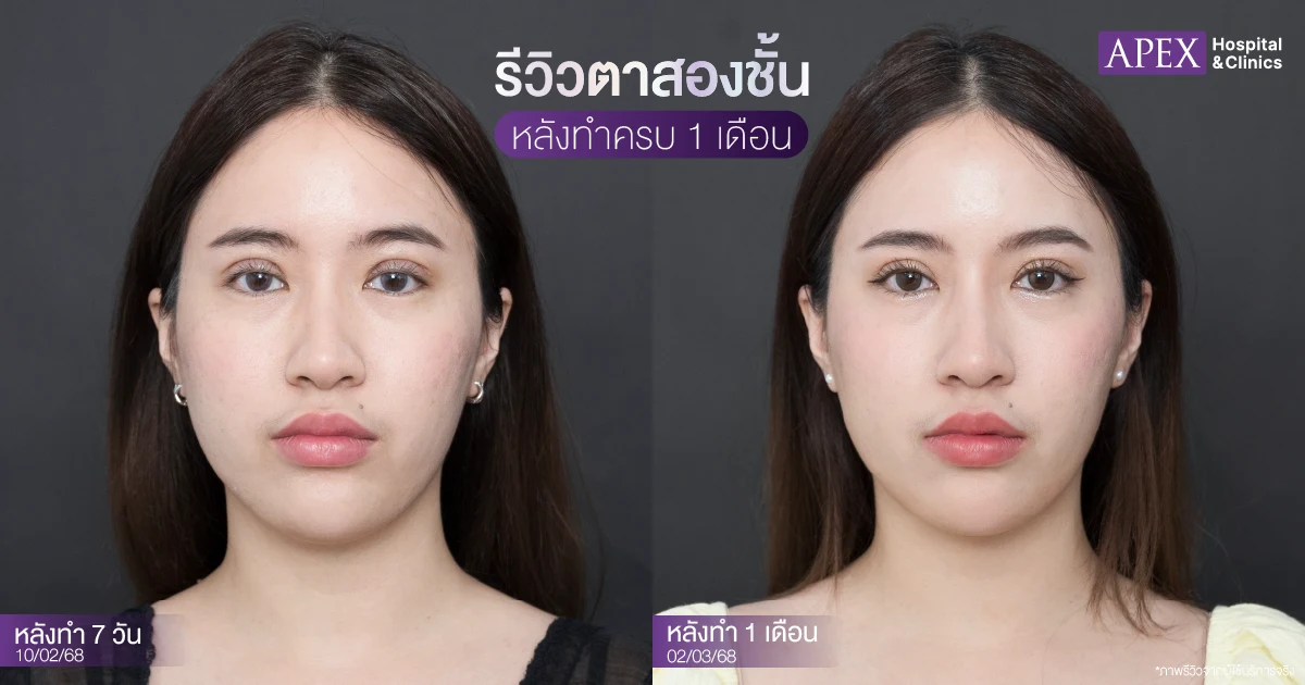 รีวิวตาสองชั้นหลังทำ 1 เดือน