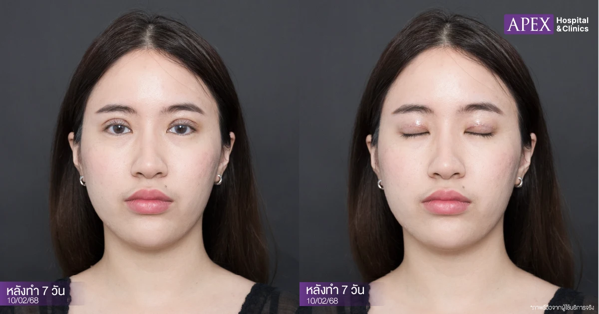 รีวิวตาสองชั้นหลังทำ 7 วัน