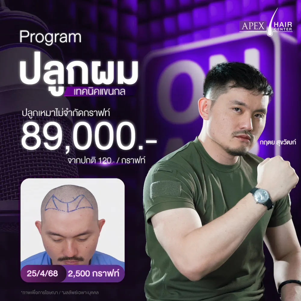 โปรโมชั่นปลูกผม ราคา 89,000 บาท