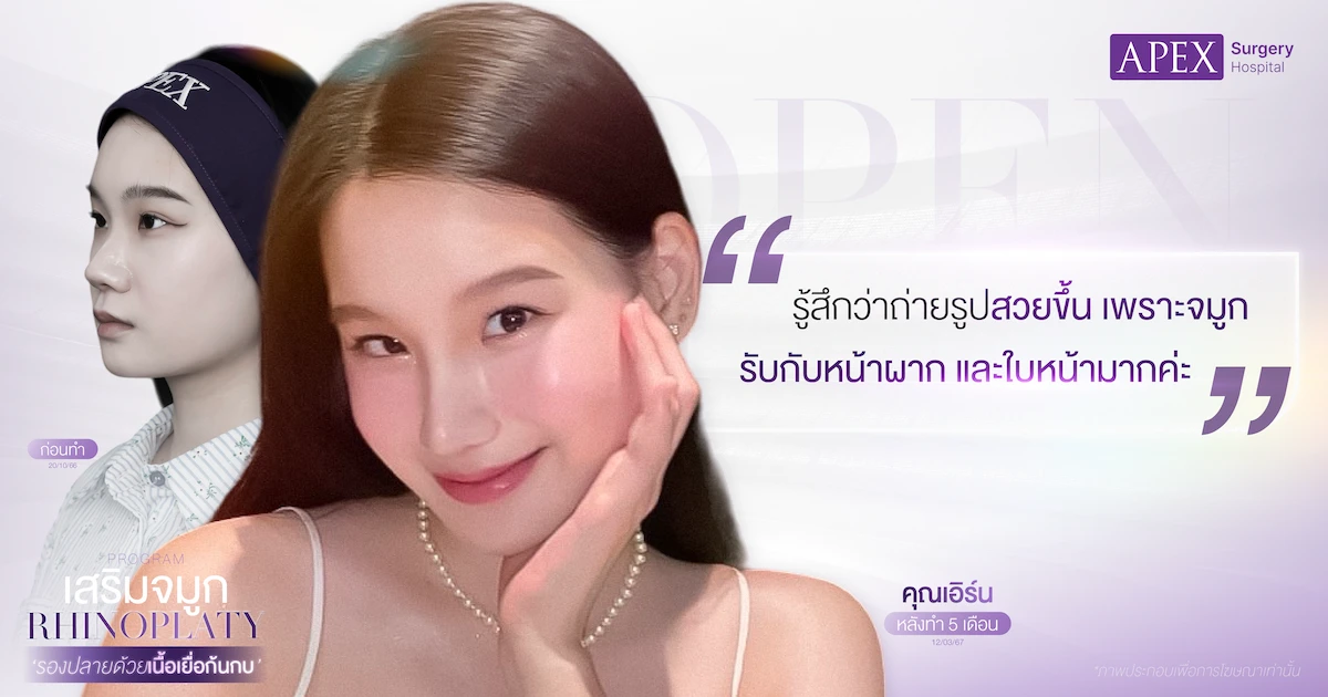รีวิวเสริมจมูกแบบเปิด