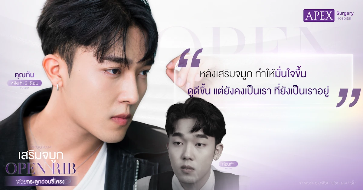 รีวิวเสริมจมูกกระดูกอ่อนซี่โครง