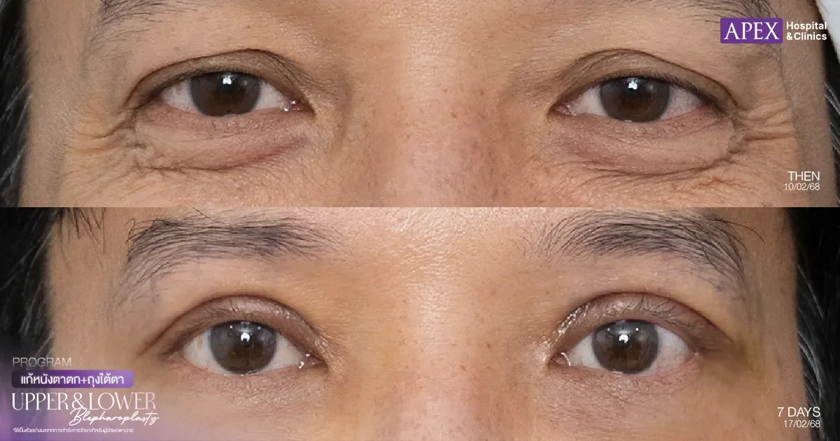 รีวิวรักษาถุงใต้ตา