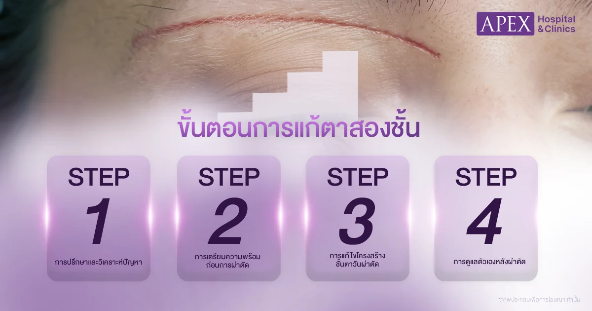 ขั้นตอนแก้ตาสองชั้น