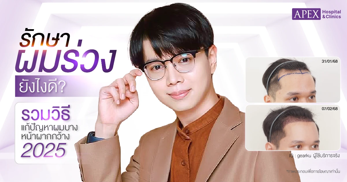 รักษาผมร่วง