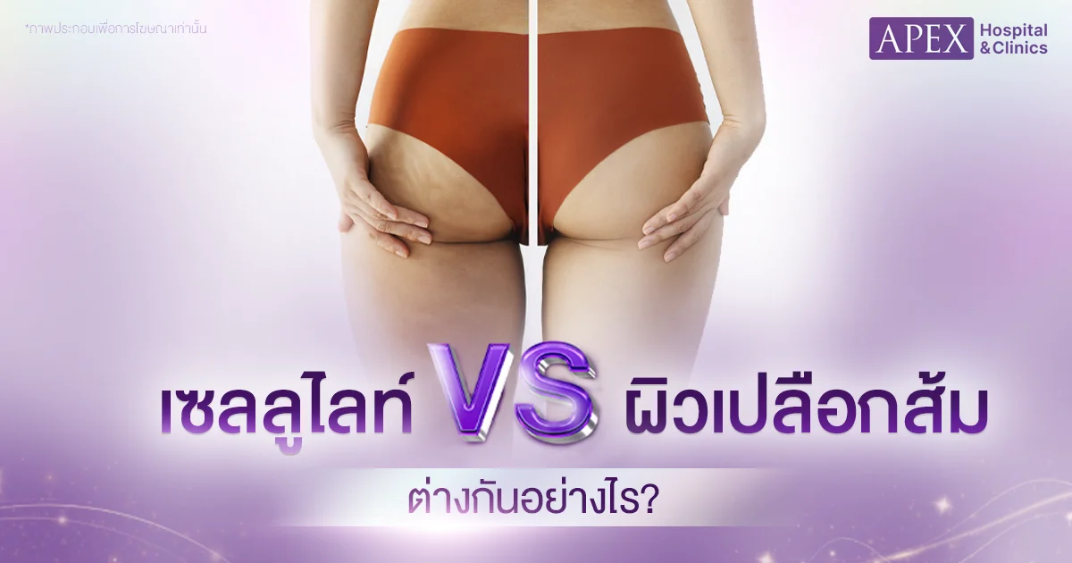 เซลลูไลท์ VS ผิวเปลือกส้ม