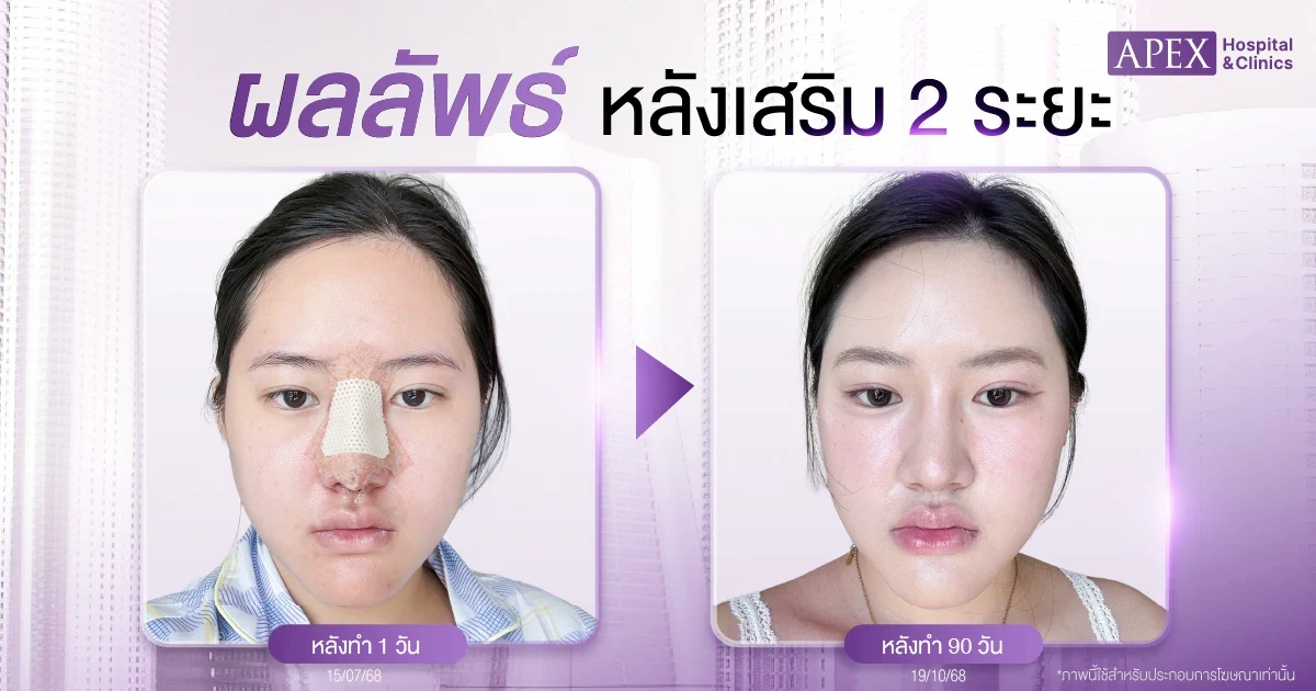 รีวิวเสริมจมูก