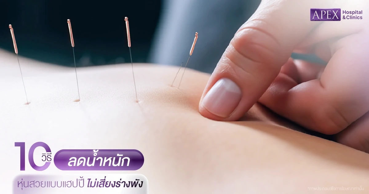 ฝังเข็มลดน้ำหนัก