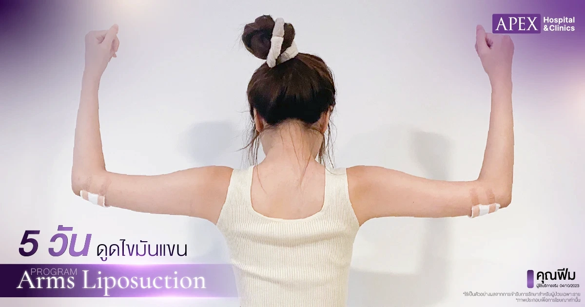 รีวิวดูดไขมันต้นแขน