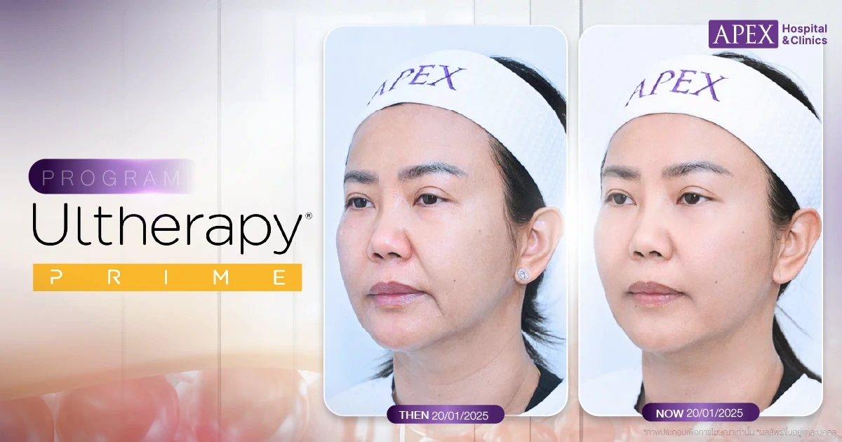 รีวิวยกกระชับหน้า Ulthera Prime