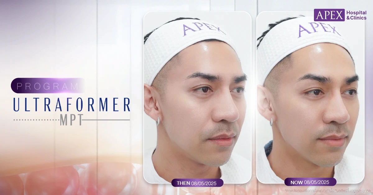 รีวิวยกกระชับหน้า Ultraformer