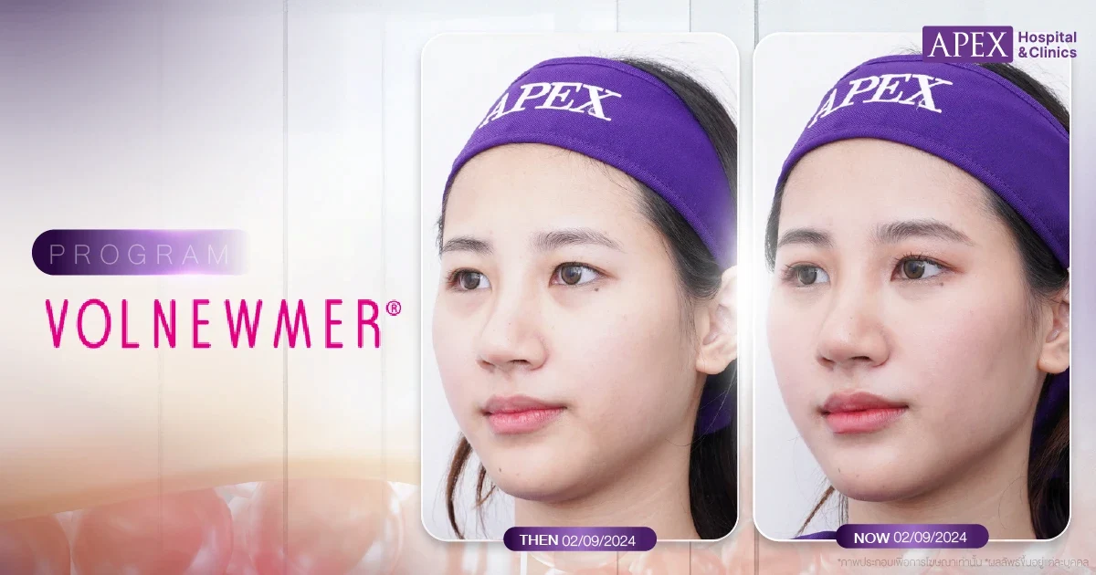 รีวิวยกกระชับหน้า Volnewmer