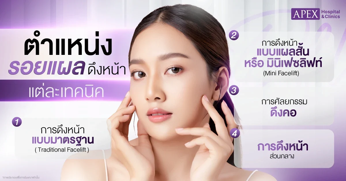 ตำแหน่งรอยแผลดึงหน้า