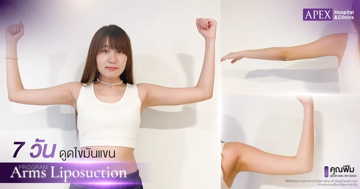 รีวิวหลังดูดไขมันแขน