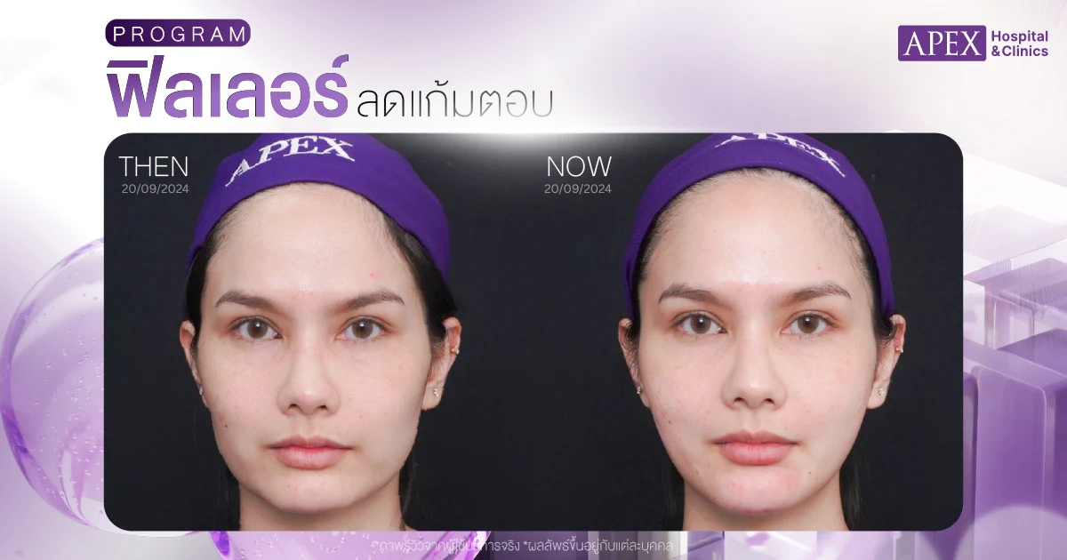 รีวิวฟิลเลอร์แก้มตอบ