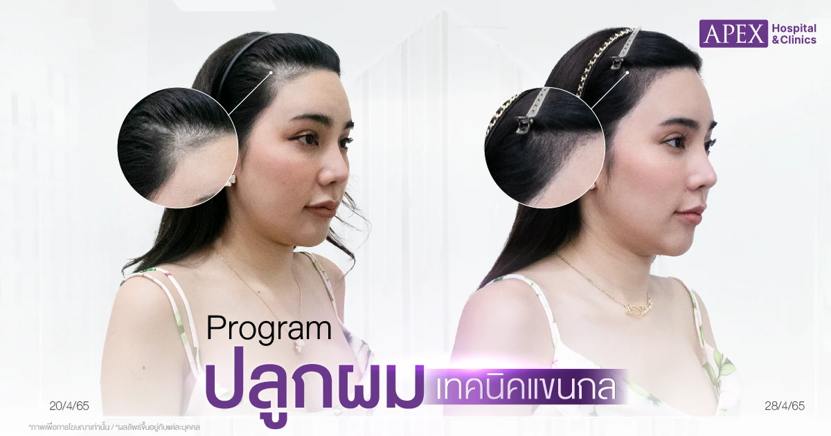 รีวิวปลูกผมราคาเท่าไหร่