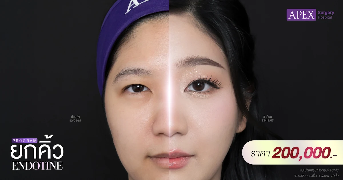 ยกคิ้ว Endotine ราคา