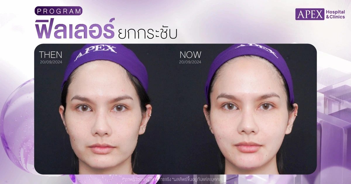 ฟิลเลอร์ยกกระชับหน้า