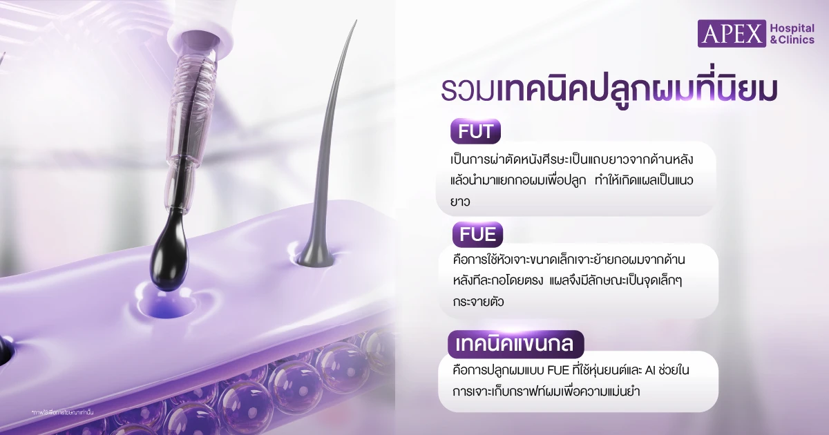 ราคาปลูกผมเท่าไหร่ แต่ละเทคนิค