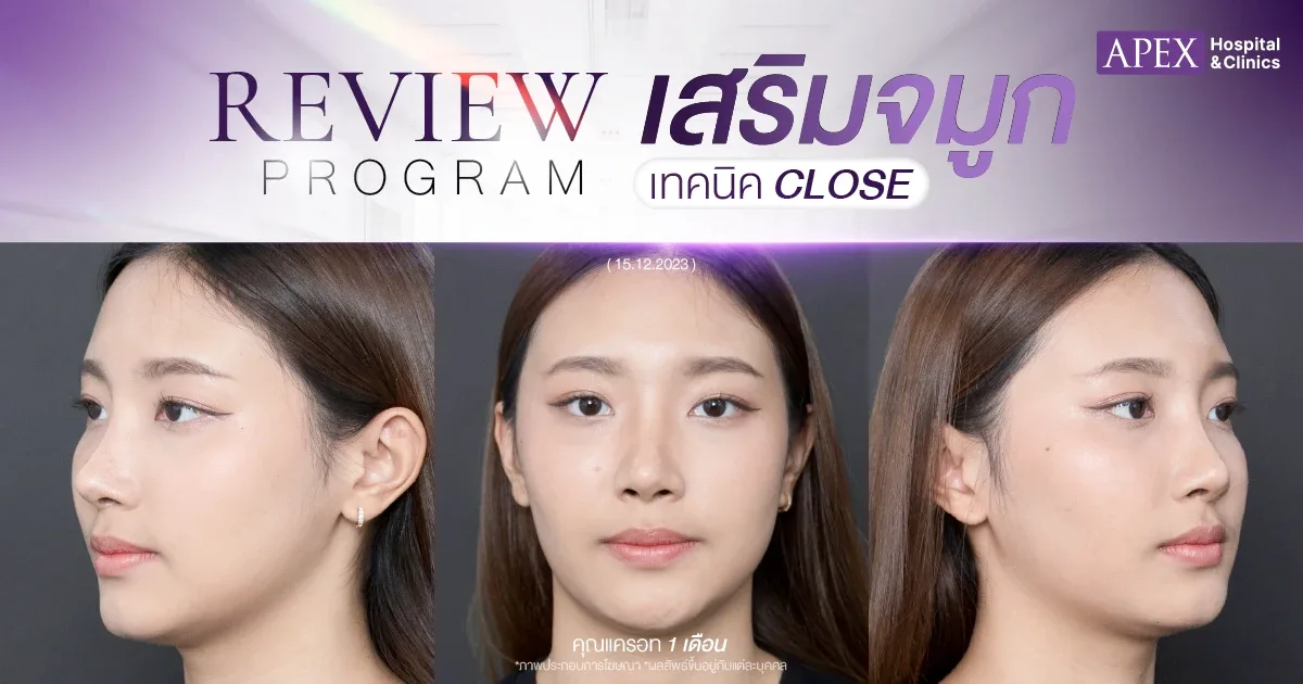 รีวิวเสริมจมูก 1 เดือน