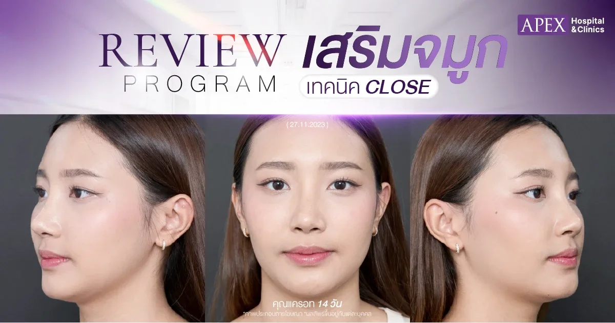 รีวิวเสริมจมูก 14 วัน