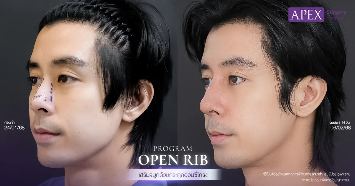 รีวิวเสริมจมูกเอเพ็กซ์