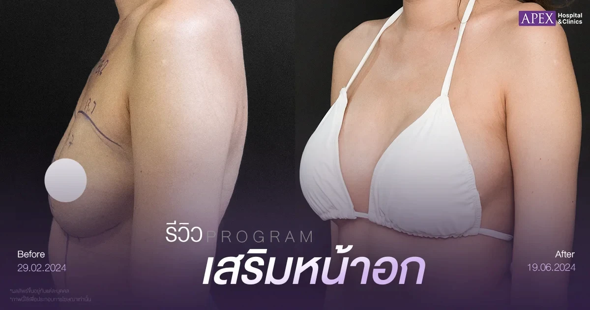 รีวิวเสริมหน้าอกขนาดหน้าอกคัพ C