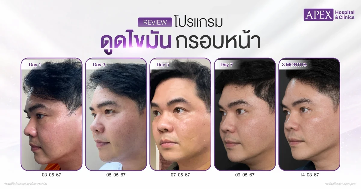 รีวิวดูดไขมันกรอบหน้า