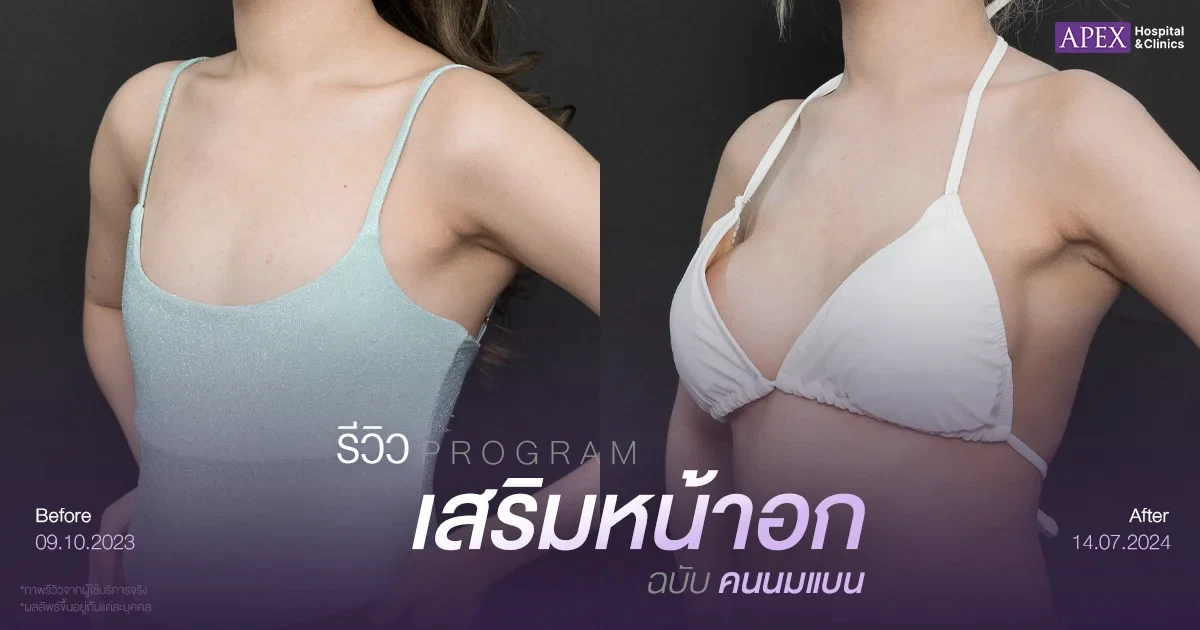 รีวิวเสริมหน้าอกฉบับคนนมแบน